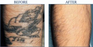 places to remove tattoos houston North Houston Laser Tattoo Removal
