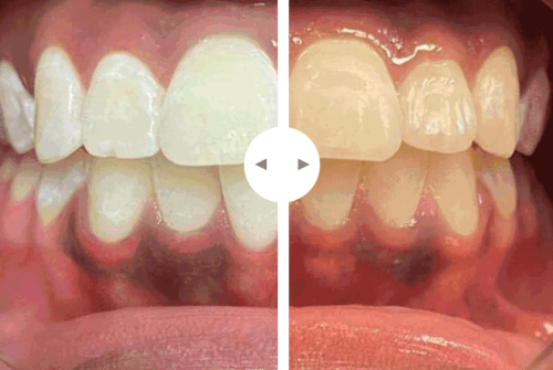 teeth whitening in houston Naturally White Teeth Whitening