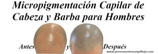 Ver aquí más información de Micropigmentación Capilar de Cabeza y Barba para Hombres.